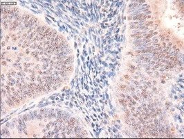 IHC-P analysis of human endometrium adenocarcinoma tissue using GTX83771 PTCH1 antibody [5c7]. Antigen retrieval : Heat-induced epitope retrieval by 10mM citrate buffer, pH6.0, 100oC for 10min.