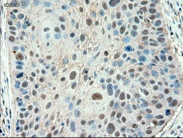 IHC-P analysis of human lung carcinoma tissue using GTX83771 PTCH1 antibody [5c7]. Antigen retrieval : Heat-induced epitope retrieval by 10mM citrate buffer, pH6.0, 100oC for 10min.