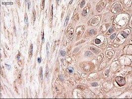 IHC-P analysis of human pancreas carcinoma tissue using GTX83771 PTCH1 antibody [5c7]. Antigen retrieval : Heat-induced epitope retrieval by 10mM citrate buffer, pH6.0, 100oC for 10min.