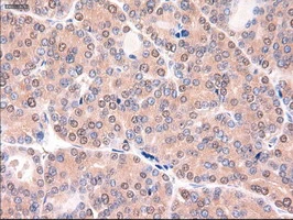 IHC-P analysis of human thyroid carcinoma tissue using GTX83771 PTCH1 antibody [5c7]. Antigen retrieval : Heat-induced epitope retrieval by 10mM citrate buffer, pH6.0, 100oC for 10min.