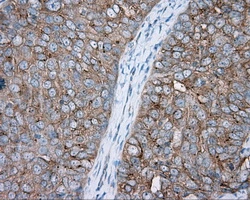 IHC-P analysis of human ovary adenocarcinoma tissue using GTX83823 PKA R2 antibody [1A7]. Antigen retrieval : Heat-induced epitope retrieval by 10mM citrate buffer, pH6.0, 100oC for 10min. Dilution : 1:50
