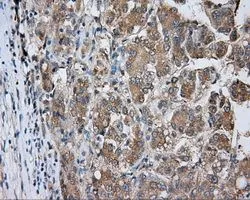 IHC-P analysis of liver carcinoma tissue using GTX83823 PKA R2 antibody [1A7]. Antigen retrieval : Heat-induced epitope retrieval by 10mM citrate buffer, pH6.0, 100oC for 10min. Dilution : 1:50