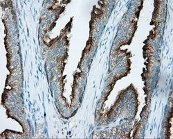 IHC-P analysis of prostate tissue using GTX83823 PKA R2 antibody [1A7]. Antigen retrieval : Heat-induced epitope retrieval by 10mM citrate buffer, pH6.0, 100oC for 10min. Dilution : 1:50