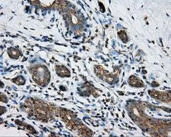 IHC-P analysis of breast tissue using GTX83825 PKA R2 antibody [4A3]. Antigen retrieval : Heat-induced epitope retrieval by 10mM citrate buffer, pH6.0, 100oC for 10min. Dilution : 1:50