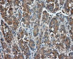 IHC-P analysis of liver carcinoma tissue using GTX83825 PKA R2 antibody [4A3]. Antigen retrieval : Heat-induced epitope retrieval by 10mM citrate buffer, pH6.0, 100oC for 10min. Dilution : 1:50