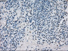 IHC-P analysis of human thyroid carcinoma tissue using GTX83840 PPP5C antibody [5G5]. Antigen retrieval : Heat-induced epitope retrieval by 10mM citrate buffer, pH6.0, 100oC for 10min.