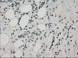 IHC-P analysis of human pancreas carcinoma tissue using GTX83843 PPP1R7 antibody [4F9]. Antigen retrieval : Heat-induced epitope retrieval by 10mM citrate buffer, pH6.0, 100oC for 10min.