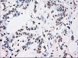 IHC-P analysis of human colon adenocarcinoma tissue using GTX83865 PLK1 antibody [1D4]. Antigen retrieval : Heat-induced epitope retrieval by 10mM citrate buffer, pH6.0, 100oC for 10min.