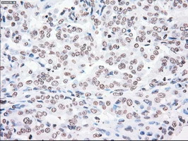 IHC-P analysis of human endometrium adenocarcinoma tissue using GTX83865 PLK1 antibody [1D4]. Antigen retrieval : Heat-induced epitope retrieval by 10mM citrate buffer, pH6.0, 100oC for 10min.