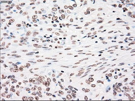 IHC-P analysis of human bladder carcinoma tissue using GTX83865 PLK1 antibody [1D4]. Antigen retrieval : Heat-induced epitope retrieval by 10mM citrate buffer, pH6.0, 100oC for 10min.