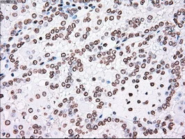 IHC-P analysis of human kidney carcinoma tissue using GTX83865 PLK1 antibody [1D4]. Antigen retrieval : Heat-induced epitope retrieval by 10mM citrate buffer, pH6.0, 100oC for 10min.