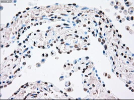 IHC-P analysis of human lung carcinoma tissue using GTX83865 PLK1 antibody [1D4]. Antigen retrieval : Heat-induced epitope retrieval by 10mM citrate buffer, pH6.0, 100oC for 10min.