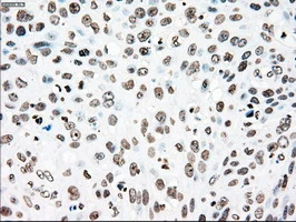 IHC-P analysis of human pancreas carcinoma tissue using GTX83865 PLK1 antibody [1D4]. Antigen retrieval : Heat-induced epitope retrieval by 10mM citrate buffer, pH6.0, 100oC for 10min.
