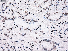 IHC-P analysis of human prostate carcinoma tissue using GTX83865 PLK1 antibody [1D4]. Antigen retrieval : Heat-induced epitope retrieval by 10mM citrate buffer, pH6.0, 100oC for 10min.