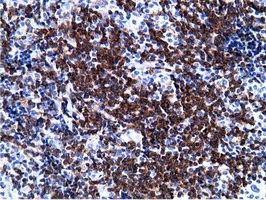 IHC-P analysis of human lymphoma tissue using GTX83893 PIK3AP1 antibody [7A11]. Antigen retrieval : Heat-induced epitope retrieval by 10mM citrate buffer, pH6.0, 100oC for 10min.