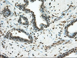 IHC-P analysis of human prostate carcinoma tissue using GTX83922 PDE4A antibody [7B11]. Antigen retrieval : Heat-induced epitope retrieval by 10mM citrate buffer, pH6.0, 100oC for 10min. Dilution : 1:50