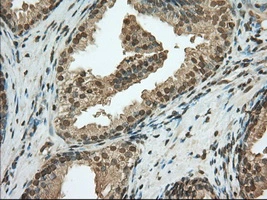 IHC-P analysis of human prostate tissue using GTX83922 PDE4A antibody [7B11]. Antigen retrieval : Heat-induced epitope retrieval by 10mM citrate buffer, pH6.0, 100oC for 10min. Dilution : 1:50