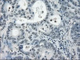IHC-P analysis of colon adenocarcinoma tissue using GTX83933 PDE10A antibody [1C9]. Antigen retrieval : Heat-induced epitope retrieval by 10mM citrate buffer, pH6.0, 100oC for 10min. Dilution : 1:50
