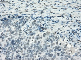 IHC-P analysis of human ovary adenocarcinoma tissue using GTX83933 PDE10A antibody [1C9]. Antigen retrieval : Heat-induced epitope retrieval by 10mM citrate buffer, pH6.0, 100oC for 10min. Dilution : 1:50