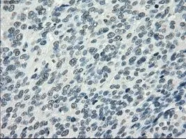 IHC-P analysis of bladder carcinoma tissue using GTX83933 PDE10A antibody [1C9]. Antigen retrieval : Heat-induced epitope retrieval by 10mM citrate buffer, pH6.0, 100oC for 10min. Dilution : 1:50
