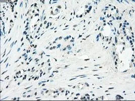 IHC-P analysis of prostate carcinoma tissue using GTX83933 PDE10A antibody [1C9]. Antigen retrieval : Heat-induced epitope retrieval by 10mM citrate buffer, pH6.0, 100oC for 10min. Dilution : 1:50