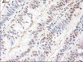 IHC-P analysis of colon adenocarcinoma tissue using GTX83983 Neurotrophin 3 antibody [5C7]. Antigen retrieval : Heat-induced epitope retrieval by 10mM citrate buffer, pH6.0, 100oC for 10min.