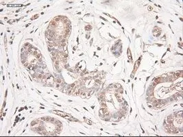 IHC-P analysis of breast tissue using GTX83983 Neurotrophin 3 antibody [5C7]. Antigen retrieval : Heat-induced epitope retrieval by 10mM citrate buffer, pH6.0, 100oC for 10min.