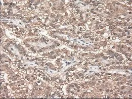 IHC-P analysis of kidney carcinoma tissue using GTX83983 Neurotrophin 3 antibody [5C7]. Antigen retrieval : Heat-induced epitope retrieval by 10mM citrate buffer, pH6.0, 100oC for 10min.