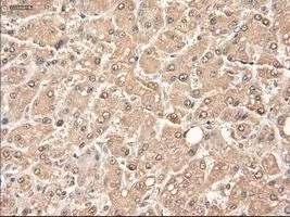 IHC-P analysis of liver carcinoma tissue using GTX83983 Neurotrophin 3 antibody [5C7]. Antigen retrieval : Heat-induced epitope retrieval by 10mM citrate buffer, pH6.0, 100oC for 10min.