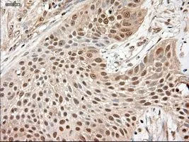 IHC-P analysis of lung carcinoma tissue using GTX83983 Neurotrophin 3 antibody [5C7]. Antigen retrieval : Heat-induced epitope retrieval by 10mM citrate buffer, pH6.0, 100oC for 10min.