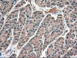 IHC-P analysis of thyroid carcinoma tissue using GTX83983 Neurotrophin 3 antibody [5C7]. Antigen retrieval : Heat-induced epitope retrieval by 10mM citrate buffer, pH6.0, 100oC for 10min.
