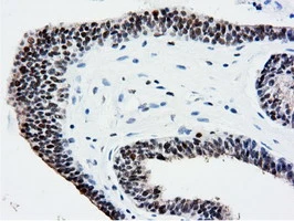 IHC-P analysis of human endometrium adenocarcinoma tissue using GTX83992 NT5DC1 antibody [1E11]. Antigen retrieval : Heat-induced epitope retrieval by 10mM citrate buffer, pH6.0, 100oC for 10min.