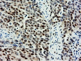 IHC-P analysis of human ovary adenocarcinoma tissue using GTX83992 NT5DC1 antibody [1E11]. Antigen retrieval : Heat-induced epitope retrieval by 10mM citrate buffer, pH6.0, 100oC for 10min.