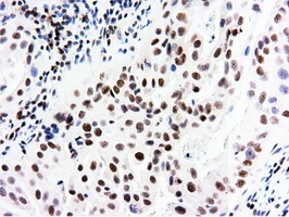 IHC-P analysis of human bladder carcinoma tissue using GTX83992 NT5DC1 antibody [1E11]. Antigen retrieval : Heat-induced epitope retrieval by 10mM citrate buffer, pH6.0, 100oC for 10min.