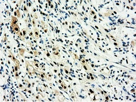 IHC-P analysis of human kidney carcinoma tissue using GTX83992 NT5DC1 antibody [1E11]. Antigen retrieval : Heat-induced epitope retrieval by 10mM citrate buffer, pH6.0, 100oC for 10min.