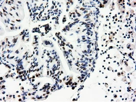 IHC-P analysis of human lung carcinoma tissue using GTX83992 NT5DC1 antibody [1E11]. Antigen retrieval : Heat-induced epitope retrieval by 10mM citrate buffer, pH6.0, 100oC for 10min.