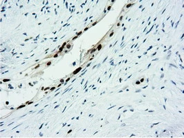 IHC-P analysis of human pancreas carcinoma tissue using GTX83992 NT5DC1 antibody [1E11]. Antigen retrieval : Heat-induced epitope retrieval by 10mM citrate buffer, pH6.0, 100oC for 10min.