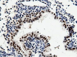 IHC-P analysis of human prostate carcinoma tissue using GTX83992 NT5DC1 antibody [1E11]. Antigen retrieval : Heat-induced epitope retrieval by 10mM citrate buffer, pH6.0, 100oC for 10min.
