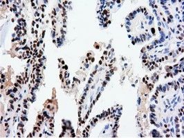 IHC-P analysis of human thyroid carcinoma tissue using GTX83992 NT5DC1 antibody [1E11]. Antigen retrieval : Heat-induced epitope retrieval by 10mM citrate buffer, pH6.0, 100oC for 10min.