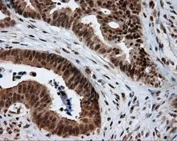 IHC-P analysis of colon adenocarcinoma tissue using GTX84010 NPR-C antibody [4C3]. Antigen retrieval : Heat-induced epitope retrieval by 10mM citrate buffer, pH6.0, 100oC for 10min. Dilution : 1:50