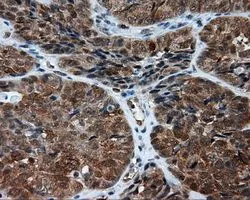 IHC-P analysis of endometrium adenocarcinoma tissue using GTX84010 NPR-C antibody [4C3]. Antigen retrieval : Heat-induced epitope retrieval by 10mM citrate buffer, pH6.0, 100oC for 10min. Dilution : 1:50