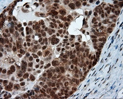 IHC-P analysis of human ovary adenocarcinoma tissue using GTX84010 NPR-C antibody [4C3]. Antigen retrieval : Heat-induced epitope retrieval by 10mM citrate buffer, pH6.0, 100oC for 10min. Dilution : 1:50