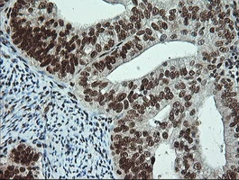 IHC-P analysis of human endometrium adenocarcinoma tissue using GTX84020 NOTCH1 antibody [4C9].