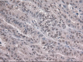 IHC-P analysis of human ovary adenocarcinoma tissue using GTX84020 NOTCH1 antibody [4C9]. Antigen retrieval : Heat-induced epitope retrieval by 10mM citrate buffer, pH6.0, 100oC for 10min. Dilution : 1:50
