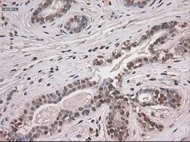IHC-P analysis of breast tissue using GTX84020 NOTCH1 antibody [4C9]. Antigen retrieval : Heat-induced epitope retrieval by 10mM citrate buffer, pH6.0, 100oC for 10min. Dilution : 1:50