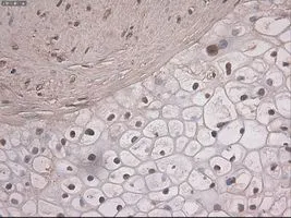 IHC-P analysis of pancreas carcinoma tissue using GTX84020 NOTCH1 antibody [4C9]. Antigen retrieval : Heat-induced epitope retrieval by 10mM citrate buffer, pH6.0, 100oC for 10min. Dilution : 1:50