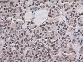 IHC-P analysis of thyroid carcinoma tissue using GTX84020 NOTCH1 antibody [4C9]. Antigen retrieval : Heat-induced epitope retrieval by 10mM citrate buffer, pH6.0, 100oC for 10min. Dilution : 1:50