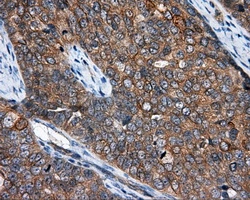 IHC-P analysis of human ovary adenocarcinoma tissue using GTX84028 NME4 antibody [5E4]. Antigen retrieval : Heat-induced epitope retrieval by 10mM citrate buffer, pH6.0, 100oC for 10min. Dilution : 1:50