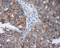 IHC-P analysis of human ovary adenocarcinoma tissue using GTX84032 NME4 antibody [1A5]. Antigen retrieval : Heat-induced epitope retrieval by 10mM citrate buffer, pH6.0, 100oC for 10min. Dilution : 1:50