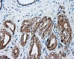 IHC-P analysis of prostate carcinoma tissue using GTX84032 NME4 antibody [1A5]. Antigen retrieval : Heat-induced epitope retrieval by 10mM citrate buffer, pH6.0, 100oC for 10min. Dilution : 1:50